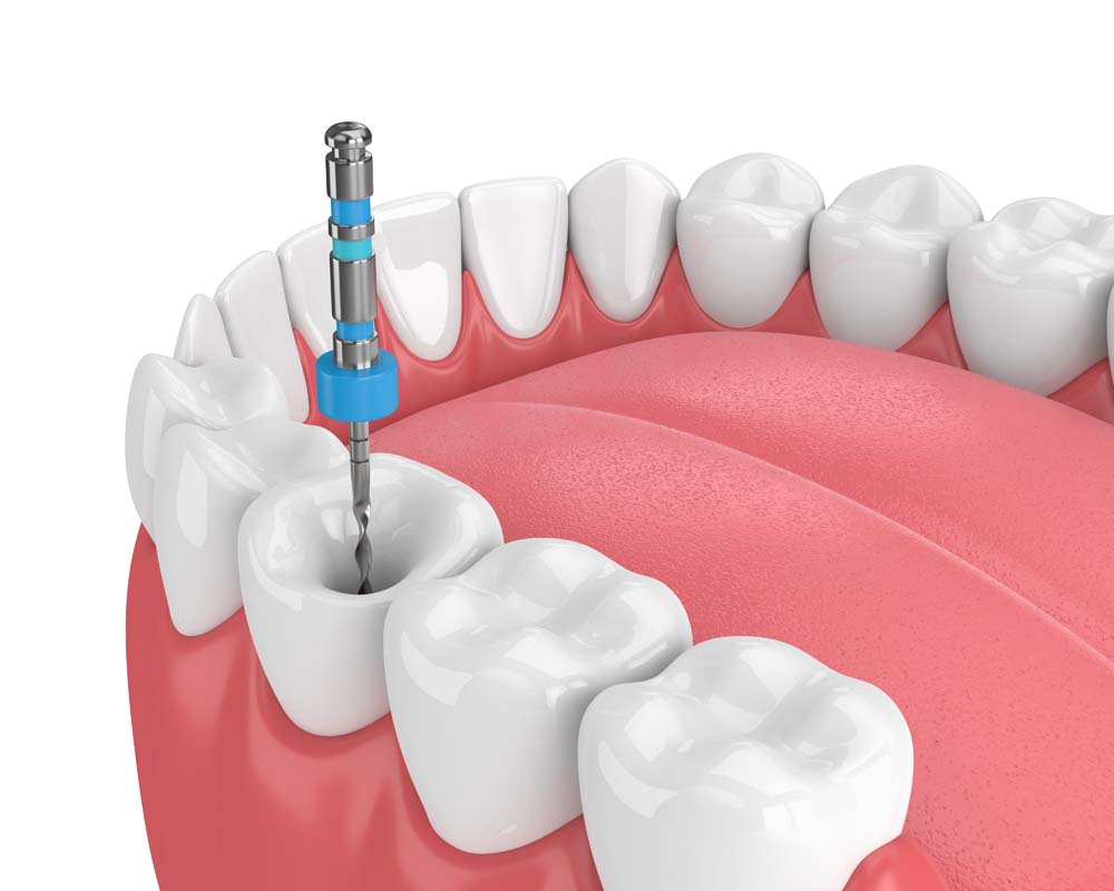 Animated Picture of Root Canal Treatment at Northern Beaches Dental Practice in Frenchs Forest