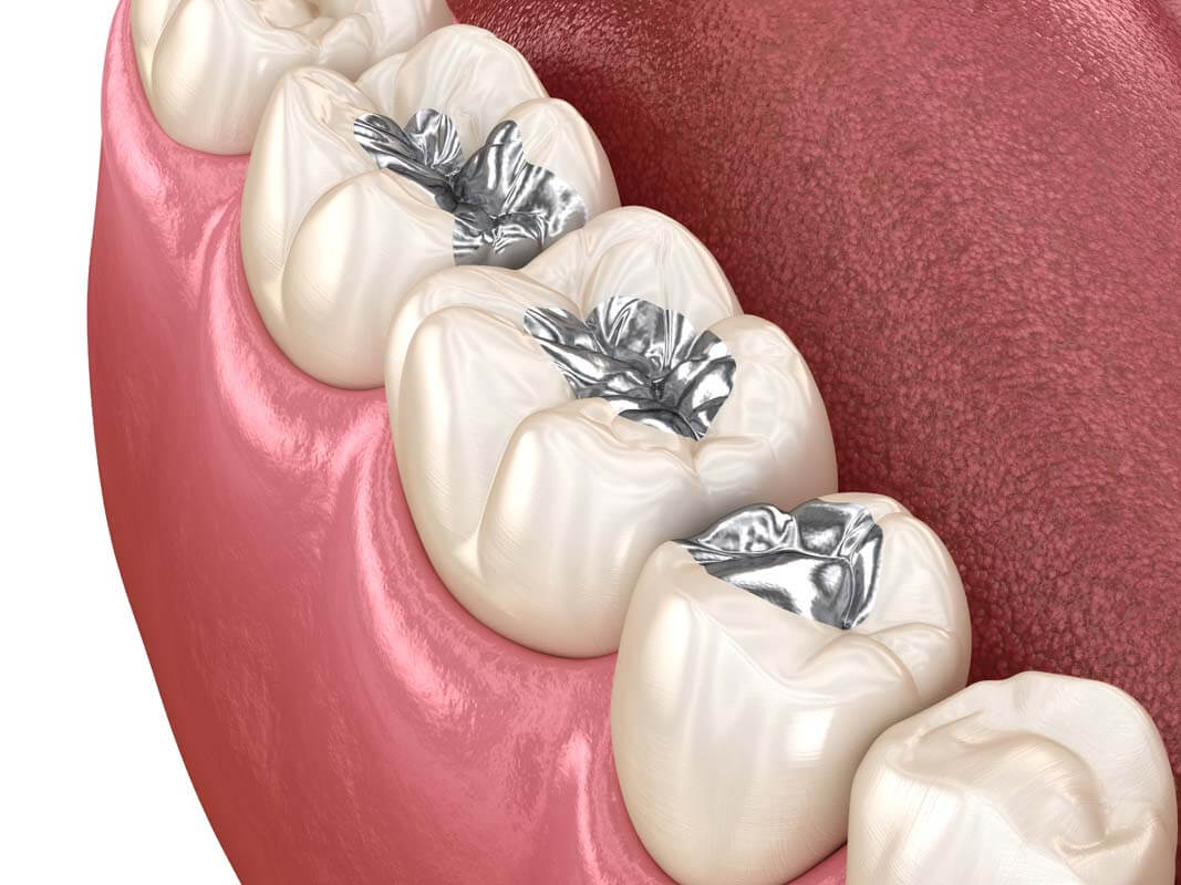 Amalgam restoration using accurate 3D animation of dental concept at northern beaches dental clinic