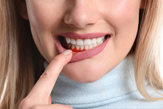 Diabetes and Gum Disease in Frenchs Forest