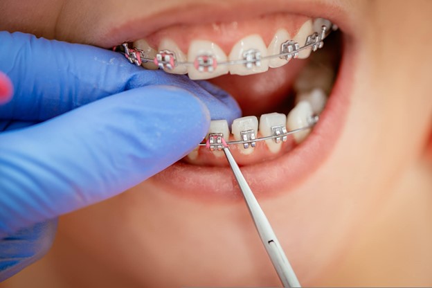 Orthodontic Treatment at Northern Beaches Dental Practice in Frenchs Forest