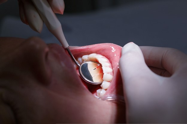 Receding Gum Treatment in Frenchs Forest