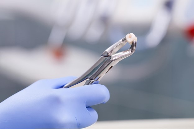 Wisdom Tooth Removal Surgery in Frenchs Forest