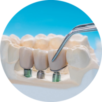 Implantology Treatment in NSW