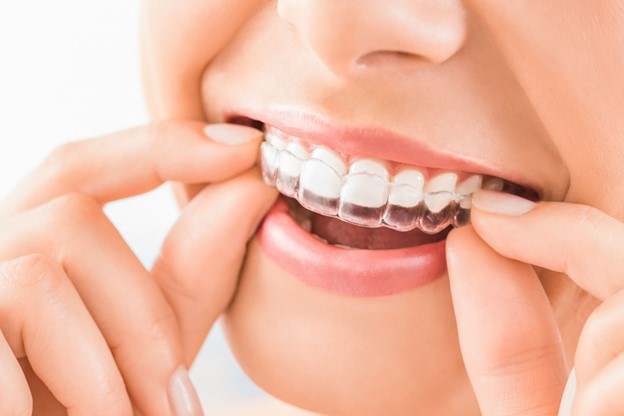 Invisalign in Frenchs Forest: Everything You Need to Know