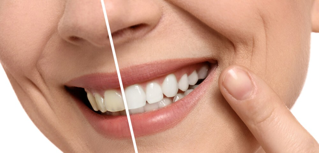 Professional vs Over-the-Counter Teeth Whitening in French Forest