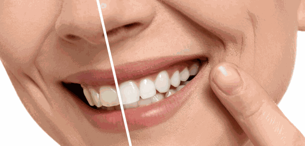 Over the Counter Teeth Whitening Options Explained for NSW