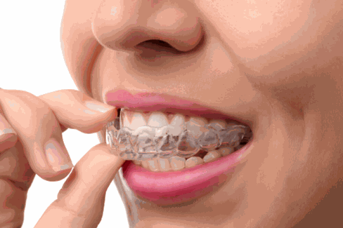 Custom mouthguards for sports safety and dental protection in NSW